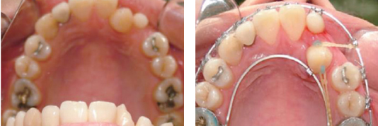 단일 치아 교정 사진1,2