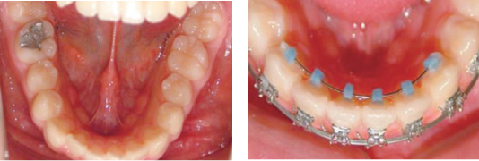 부분적으로 악화된 치아 교정1,2