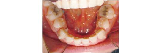 부분적으로 악화된 치아 교정1